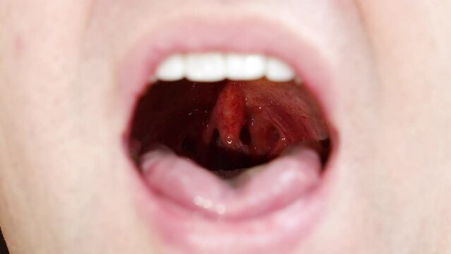 a man's mouth close-up. focus on the palatine uvula and mucous membrane of the throat. the concept of examination of the oral cavity, sore throat.
