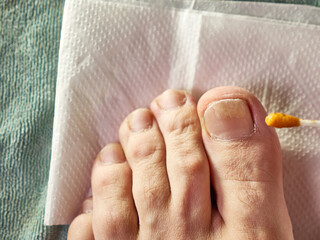 A solution of propolis is applied to the nail affected by the fungus. Treatment of fungal nail...