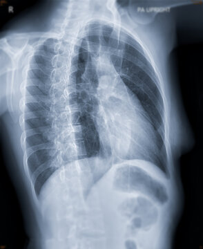 Chest x-ray image oblique view  for screening diagnosis TB,tuberculosis and covid-19.