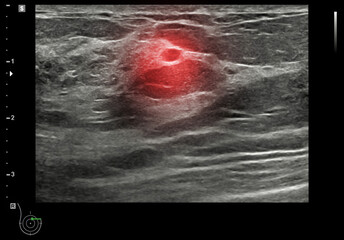 ultrasound  breast of Patient after mammogram  for diagnonsis Breast cancer in women isolated on...