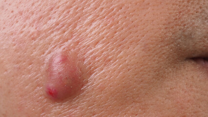 Fototapeta premium Bacterial skin infection. Big Acne Cyst Abscess or Ulcer Swollen area within face skin tissue. Containing accumulation of pus and blood. Macro shot of Acne or Dermatitis near mouth on face. Skincare.