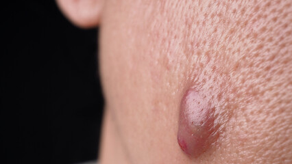 Fototapeta premium Bacterial skin infection. Big Acne Cyst Abscess or Ulcer Swollen area within face skin tissue. Containing accumulation of pus and blood. Macro shot of Acne or Dermatitis near mouth on face. Skincare.