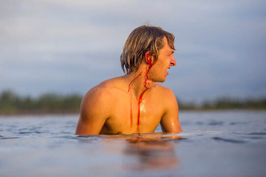 Young surfer after incident in water.
