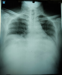 X-ray of the patient's chest with shallow inspiration
