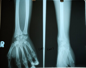X Ray of hand with dislocated ulna