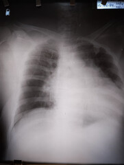 X Ray of an elderly male with an enlarged heart