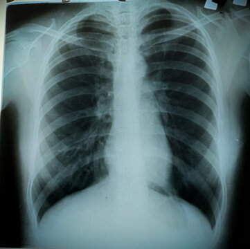 Chest X-ray of an elderly man with COPD