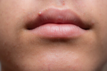 close up of a pimple
