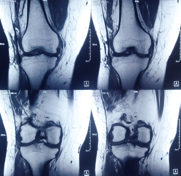 Knee joint x-ray or CT scan. Doctor pointed on area of knee joint, where pathology or problem is detected, such fracture, destruction of joint, osteoarthritis. Diagnosis of knee diseases by radiology.