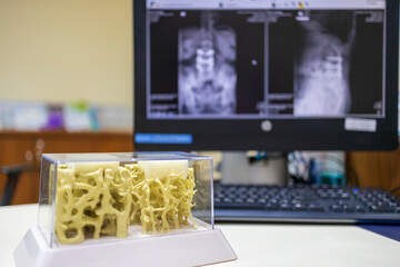 Close up photo of bone model inside examination room in hospital.Model shown osteoporosis in...