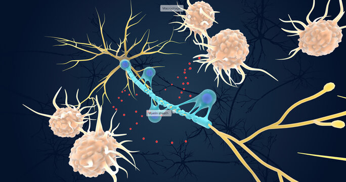 Autoimmune Attack On Myelin Sheath