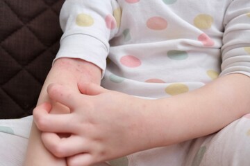 The child scratches atopic skin. The child applies a special cream to atopic skin. Dermatitis,...