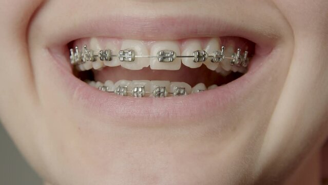 Close-up of the teeth of a young woman who smiles widely and all her teeth are visible. Young teeth, with orthodontic treatment, with metal brackets. happy customer who happily wears braces.
