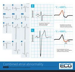 Sometimes, we can use lead V1 to measure the interval and amplitude of P wave, and simultaneously diagnose left atrial abnormality and right atrial abnormality, that is, biatrial abnormality.