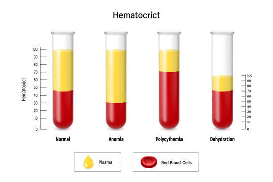 Blood analysis. Hematocrict. Normal, Anemia Polycythemia and Dehydration.