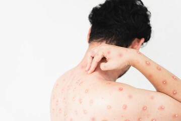 monkeypox concept, scratching, wounds and pus on the skin, back and body, white men, itching.