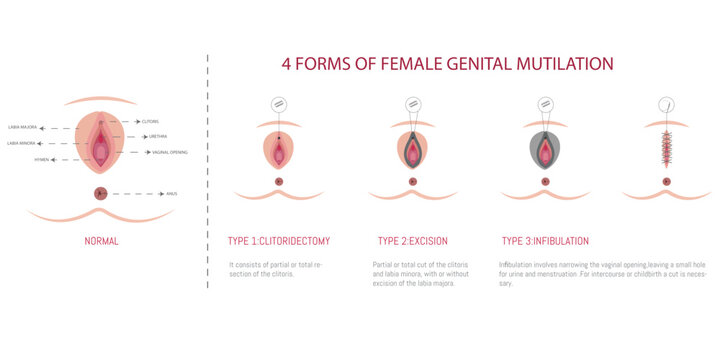 cut clitoris Female genital mutilation/cutting (FGM/C) involving the cutting of the... |  Download Scientific Diagram