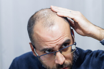 Young man with alopecia looking at his head and hair in the mirror