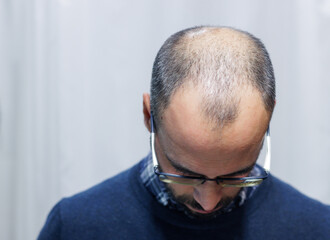 Young man with alopecia looking at his head and hair in the mirror