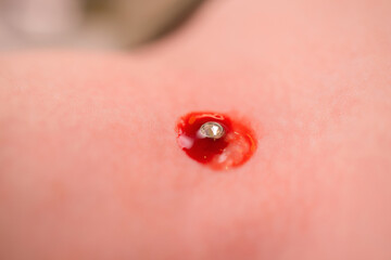 Operation to install microdermal piercing. Professional placing
