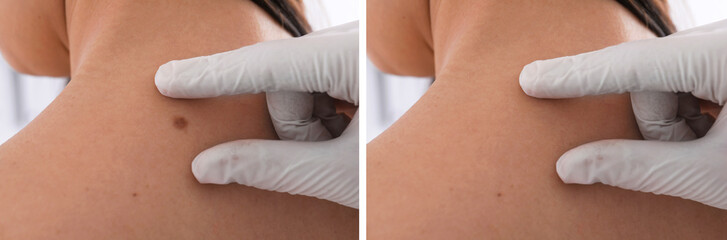 Collage with photos of patient's back before and after mole removing procedure, closeup....