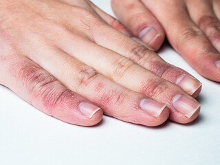 しもやけ・あかぎれ・凍傷で腫れた女性の手
