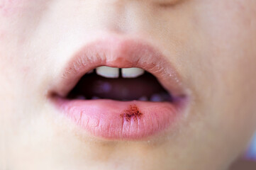 Lesion on a child's lip with blood