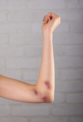 Close-up of bruises on the skin of an injured woman's arm