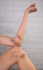 Close-up of bruises on the skin of an injured woman's arm and leg. Close up on a bruise on the skin...