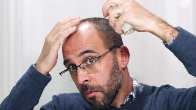 Young man with alopecia looking at his head and hair in the mirror and applying a spray medicine