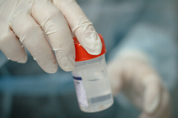 A doctor in a medical glove holds a container with a biopsy in his hand for analysis. In the hand is a jar with farmalin and a piece of biopsy to be sent to the laboratory.
