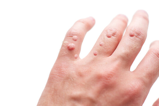 A lots of Viral warts on hand