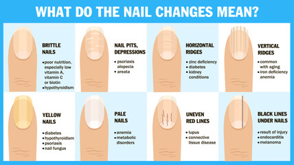 What do the nail changes mean The appearance of the nail and the associated disease. Brittle nails, nail pits, depression, horizontal, vertical ridge. Medical infographic design. Vector illustration