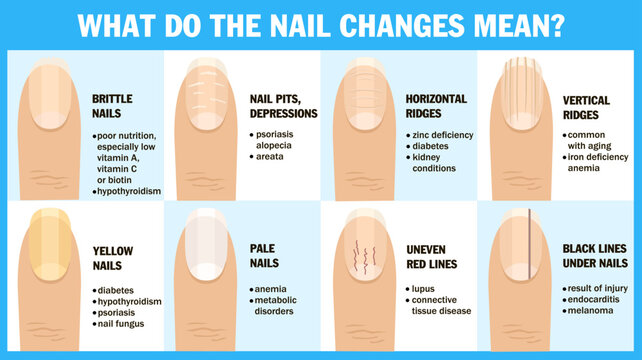 Dark Lines on Fingernails | Causes, Prevention & Treatment