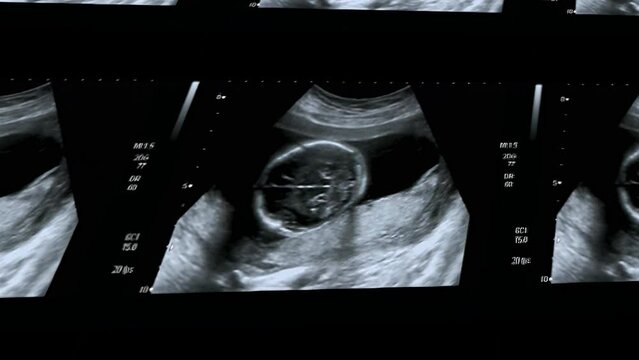 Multi screen ultrasound small baby at 12 weeks. 12 weeks pregnant ultrasound image show baby or fetus development and pregnancy health checking