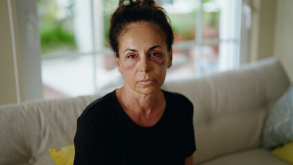 Middle age hispanic woman suffering for domestic violence with bruise on eyes at home