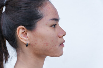 Close up of young Asian woman worry about her face when she has problems with skin on her face. Problems with acne and scar on the female skin. Problem skincare and health concept.
