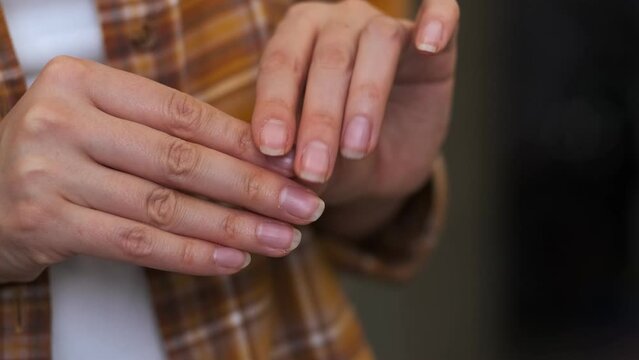 Close upwoman demonstrates groomed dry nails and cuticles. Avitaminosis and micro elements deficits . shape and do not have beautiful nail skin, indicates not to take care of both internal