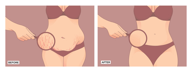 Belly fat. Before and after weight loss, woman body shape transformation, Fat To Fit. 