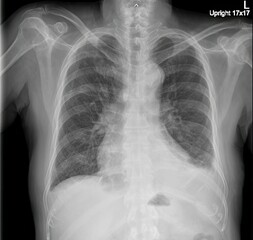 chest x-ray showing enlargement of the heart or cardiomegaly.