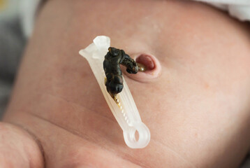 The remains of the umbilical cord in a baby after birth. Healing of the umbilical wound and...