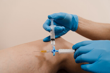 Sclerotherapy injecting into the varicose or spider vein on leg to treat blood vessel...