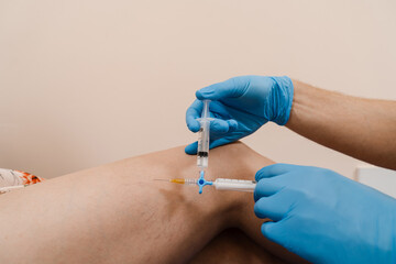 Vascular surgeon injects chemical solution into woman leg for sclerotherapy procedure. Sclerotherapy injecting into the varicose or spider vein on leg to treat blood vessel malformations. - obrazy, fototapety, plakaty