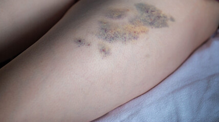 Bruises on the skin of the patient's leg after intramuscular injections of the drug. Treatment of seals and bruises after injections.