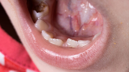 Crooked teeth in a child's mouth. The permanent tooth grows next to the milk tooth, close-up