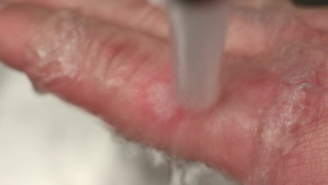 Burned skin on a finger. Caucasian man keeps hand under the cold runing water - red burned skin patch