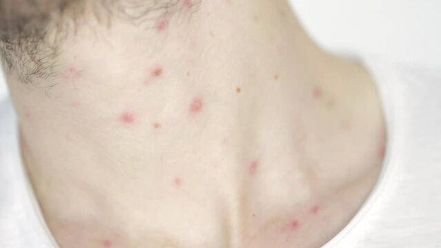 Body of adult  man have spotted, red pimple and bubble rash from monkeypox or varicella zoster virus. Medical complications after illness