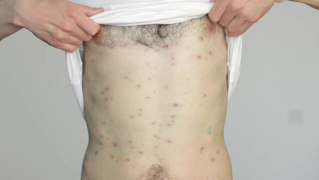 Body of adult  man have spotted, red pimple and bubble rash from chickenpox or varicella zoster virus. Medical complications after illness