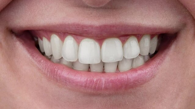 Close-up of a woman's smile before and after teeth whitening.