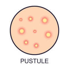 Skin pustule problems vector illustration. Sign of dry or oily skin problems isolated on white background. Health, skincare concept